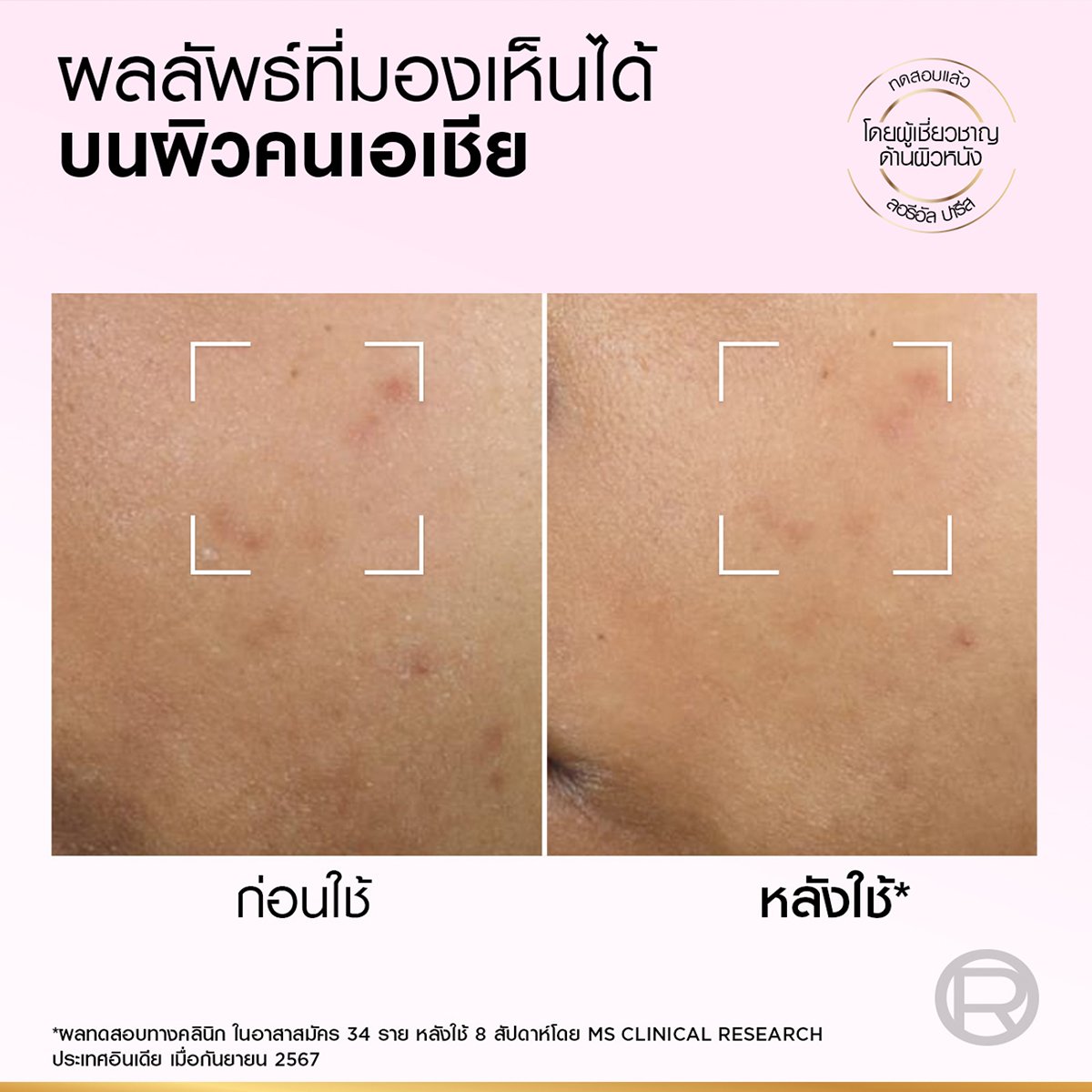 ลอรีอัล ปารีส ไกลโคลิค-ไบรท์ แอนไท-ดาร์ก สปอต เอ็กซ์โฟเลียนท์ พีล 25 มล._7